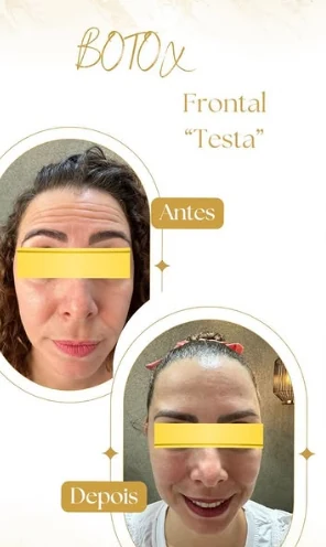 Antes e depois de aplicação de toxina botulínica na região frontal